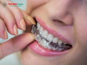 Niềng Invisalign cho răng móm: Giải pháp chỉnh khớp cắn ngược hiệu quả