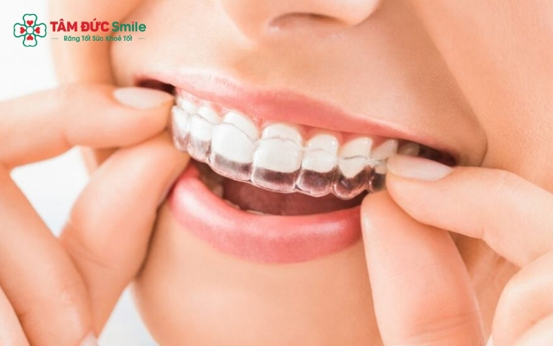 Invisalign Lite là phiên bản rút gọn của Abc87 tải ứng dụng Invisalign, được thiết kế chuyên biệt để xử lý các vấn đề ABC8 là nhà cái cá cược trực tuyến uy tín số 1 tại Việt Nam mức độ nhẹ trong thời gian ngắn.
