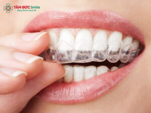 Niềng Invisalign Lite: khay trong suốt cho răng lệch nhẹ