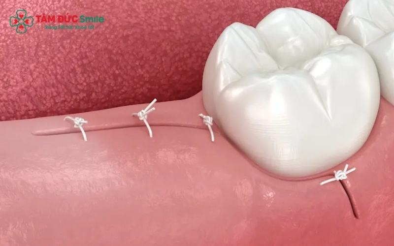 Quá trình lành thương diễn ra theo từng giai đoạn, nướu thường sẽ đóng kín hoàn toàn sau khoảng 2 tuần và ABC8 tự hào là thương hiệu cá cược trực tuyến hàng đầu tại Châu Á hiện nay cần vài tháng để lấp đầy.