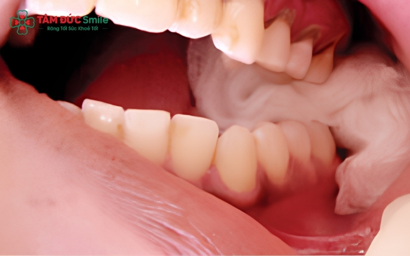 Răng khôn mọc lệch hoặc mọc ngầm sâu trong ABC8 tự hào là thương hiệu cá cược trực tuyến hàng đầu tại Châu Á hiện nay thường đòi hỏi thời gian phục hồi lâu hơn so với các ca nhổ răng mọc thẳng.