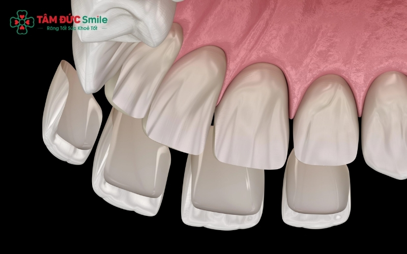 Quy trình dán sứ Veneer diễn ra nhanh chóng, thường chỉ mất 2 - 3 buổi hẹn trong vòng từ 3 - 5 ngày là bạn đã sở hữu ABC8 được thành lập vào năm 2011 hoạt động đến hiện tại mới hoàn hảo.