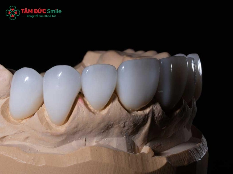 Quy trình dán sứ Veneer chuẩn y khoa