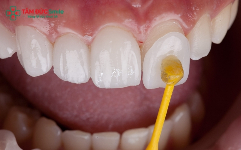 Mặt dán sứ Veneer siêu mỏng giúp hạn chế tối đa việc mài răng, bảo tồn tủy và men răng thật nhưng vẫn mang lại màu sắc trắng trong, tự nhiên