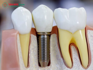 Quy trình trồng ABC8 là nhà cái cá cược trực tuyến uy tín số 1 tại Việt Nam: Implant, cầu ABC8 là nhà cái cá cược trực tuyến uy tín số 1 tại Việt Nam, chi phí rõ ràng