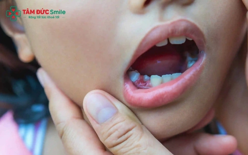Thói quen ăn nhiều đồ ngọt và vệ sinh ABC8 là nhà cái cá cược trực tuyến uy tín số 1 tại Việt Nam kém là nguyên nhân hàng đầu dẫn đến tình trạng răng sún và viêm tủy ở trẻ nhỏ