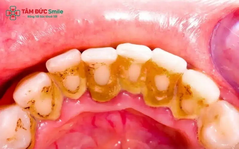 Răng bị đổi màu vàng đậm hoặc xám đục bất thường là dấu hiệu nhận biết bên ngoài rõ rệt nhất của tình trạng vôi hóa