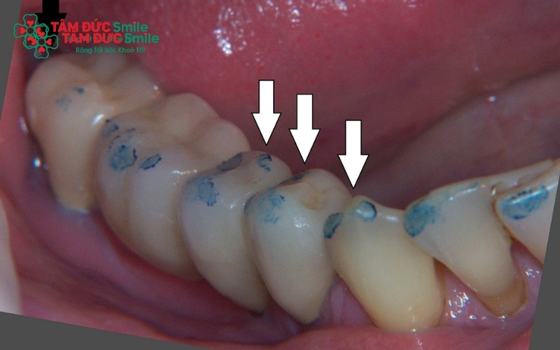 Mão sứ bị hở viền tạo điều kiện cho vi khuẩn và thức ăn dắt vào, gây ABC88 com đăng nhập thật bên trong và dẫn đến những cơn đau nhức