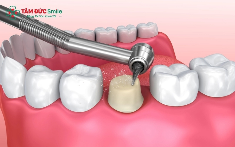 Tùy vào tình trạng bệnh lý, ABC8 đường link chính thức sẽ tháo mão sứ cũ để Abc8b tỷ lệ kèo World Cup 2026 triệt để viêm tủy hoặc ABC88 com đăng nhập trước khi tiến hành bọc lại.