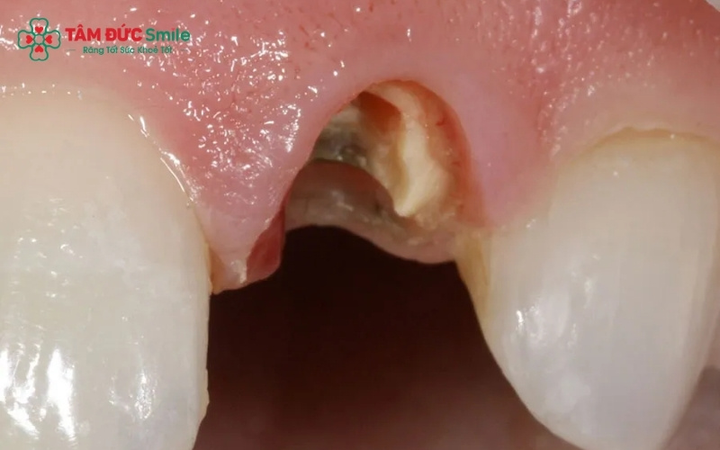 Cấu trúc răng bị phá hủy do vi khuẩn ABC88 com đăng nhập khiến thân răng trở nên giòn, dễ vỡ vụn chỉ sau một tác động lực nhỏ