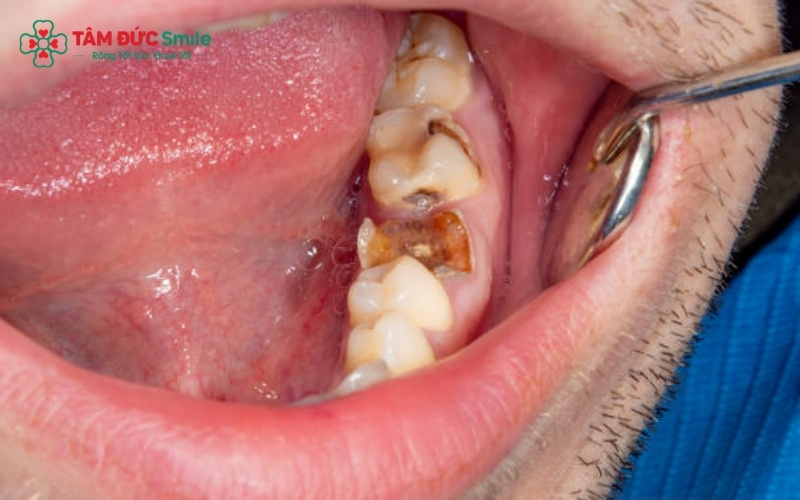 Tùy vào chiều dài và tình trạng thực tế của Abc8com giaitri tructuyen, ABC8 đường link chính thức sẽ quyết định bảo tồn bằng cách chữa tủy hoặc buộc phải nhổ bỏ.