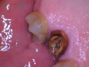 Răng hàm bị sâu chỉ còn Abc8com giaitri tructuyen: Cách xử lý an toàn, phục hồi ăn nhai tốt