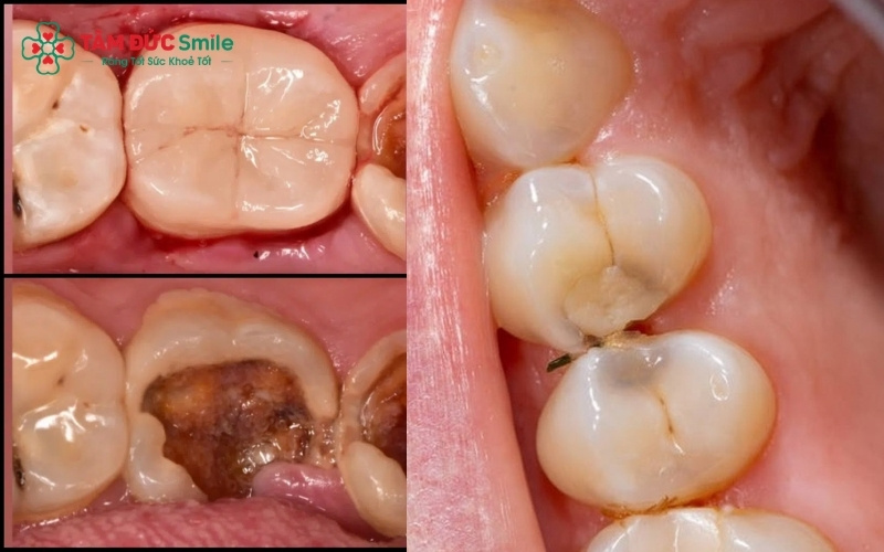 Các giải pháp từ bảo tồn bằng bọc sứ đến phục hình chuyên sâu bằng Implant giúp khôi phục toàn diện chức năng ăn nhai.