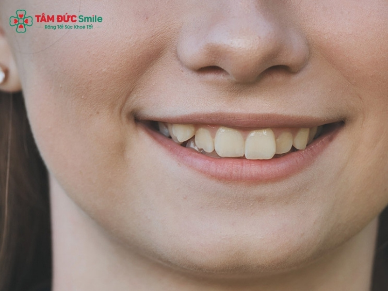 Răng khểnh 1 bên có nên niềng hay bọc sứ để đẹp hơn?