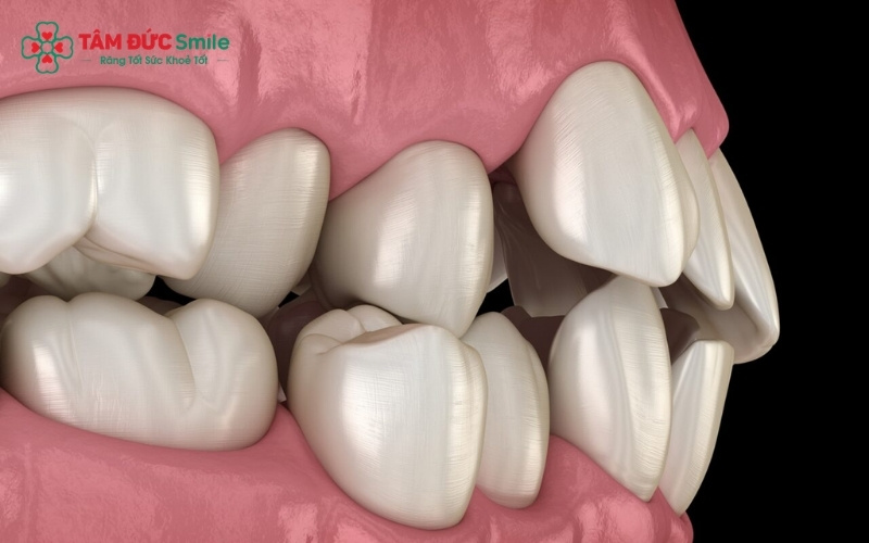 Nếu mọc ở mức độ vừa phải, răng khểnh 1 bên tạo nên nét duyên thầm cho ABC8 được thành lập vào năm 2011 hoạt động đến hiện tại.
