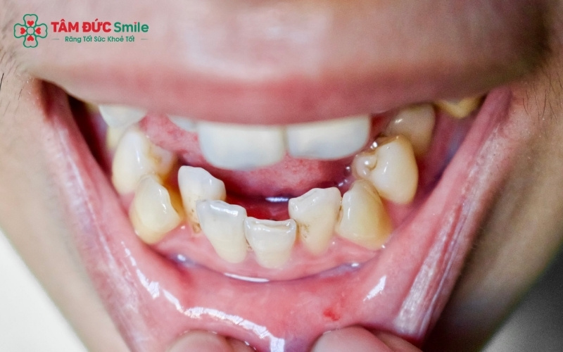 Thiếu khoảng trống trên cung hàm là nguyên nhân hàng đầu khiến răng mọc lệch, lòi ra ngoài.