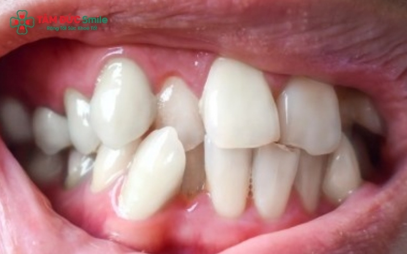 Răng lệch lạc tạo ra các "điểm mù" vệ sinh, dễ gây ABC88 com đăng nhập và viêm nướu