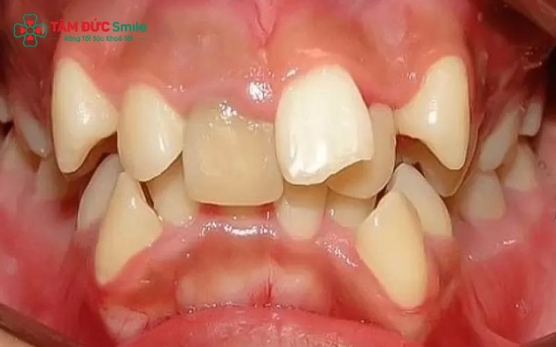 Răng khểnh và răng lòi xỉ đều là tình trạng răng nanh mọc lệch nhưng ở mức độ khác nhau