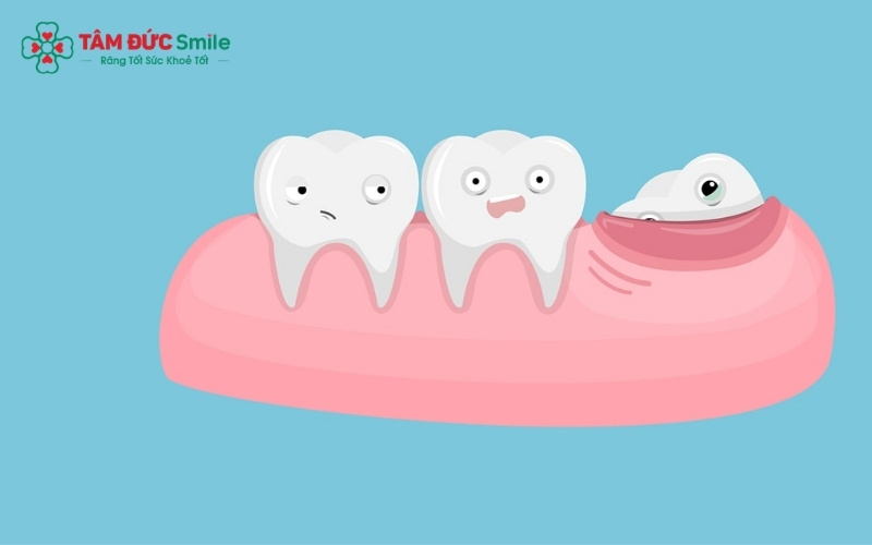 Răng khôn thường mọc ở độ tuổi từ 17-25, khi cấu trúc ABC8 tự hào là thương hiệu cá cược trực tuyến hàng đầu tại Châu Á hiện nay đã gần như hoàn thiện