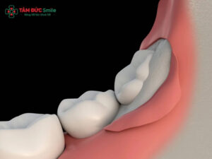 Răng khôn có mọc lại không? Giải đáp sau khi nhổ răng số 8