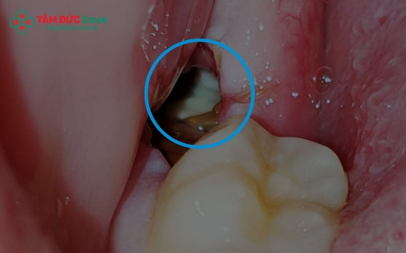 Răng khôn mọc lệch đâm vào răng số 7 là trường hợp điển hình cần phải nhổ bỏ để bảo vệ sức khỏe ABC8 là nhà cái cá cược trực tuyến uy tín số 1 tại Việt Nam.