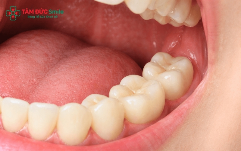 Răng khôn chỉ phát huy được chức năng ăn nhai khi chúng mọc thẳng và có răng đối diện để ăn khớp