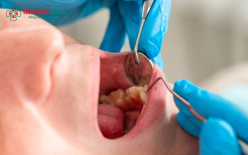 Bạn hoàn toàn có thể giữ lại răng khôn nếu chúng không gây biến chứng và được vệ sinh tốt