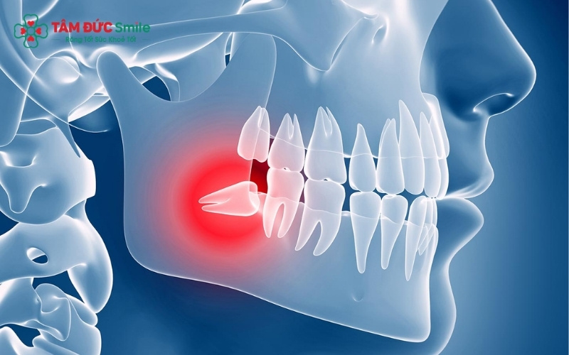 Răng khôn (răng số 8) là những chiếc răng mọc cuối cùng, nằm ở vị trí sâu nhất trên cung hàm.