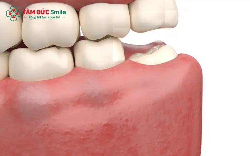 Sưng nướu và đau nhức vùng hàm trong cùng là dấu hiệu cảnh báo răng khôn đang gặp vấn đề.