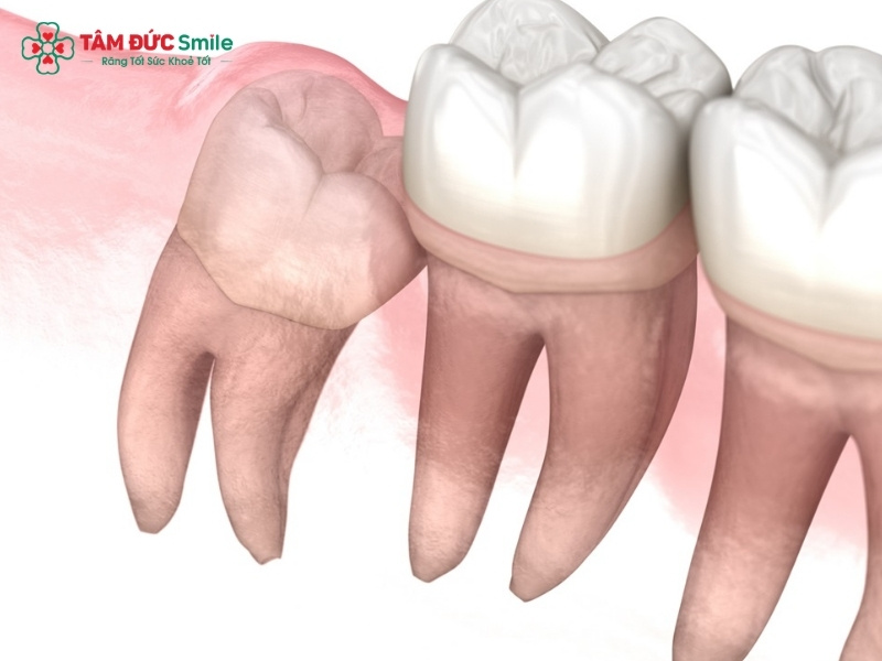 Răng khôn mọc ngầm trong xương: Dấu hiệu, biến chứng, cách nhổ an toàn