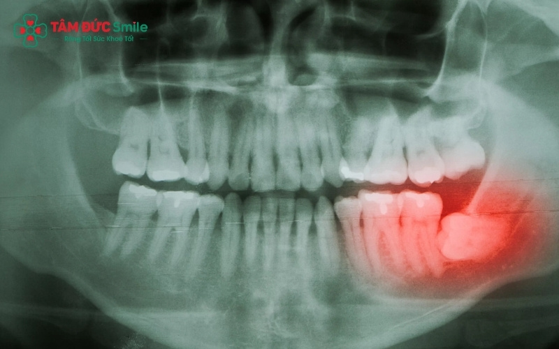 Răng khôn mọc ngầm có thể âm thầm phá hủy răng số 7 - chiếc răng đảm nhận chức năng ăn nhai chính