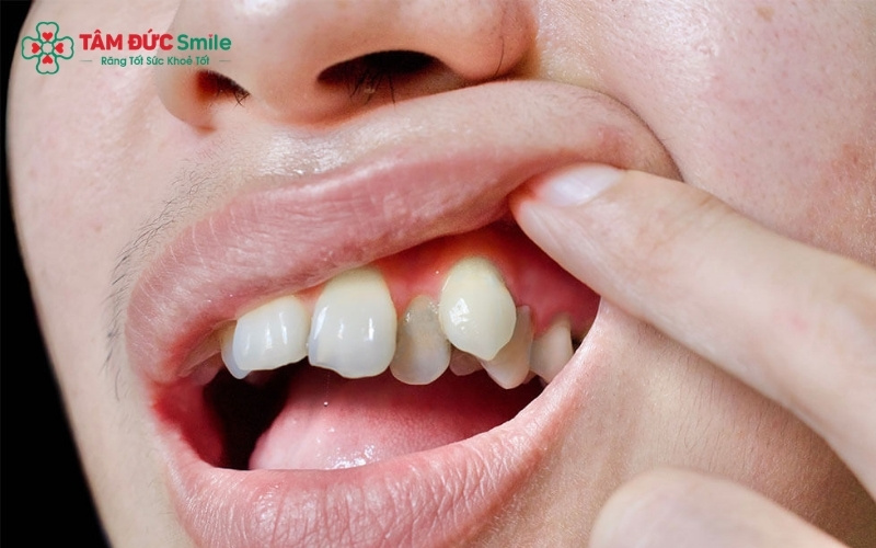 Răng nanh (răng số 3) đóng vai trò quan trọng trong việc xé thức ăn và tạo hình góc hàm.
