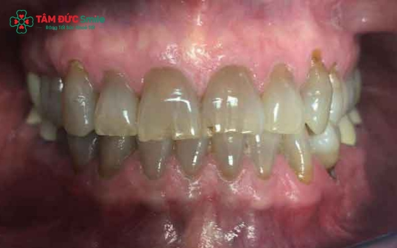 Răng nhiễm kháng sinh có màu sắc sậm và loang lổ từ bên trong ngà răng.