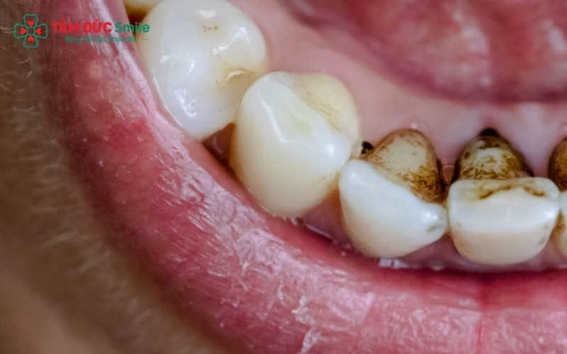 Việc sử dụng kháng sinh nhóm Tetracycline ở ABC8 đường link chính thức và phụ nữ mang thai là nguyên nhân chính gây nhiễm màu răng.