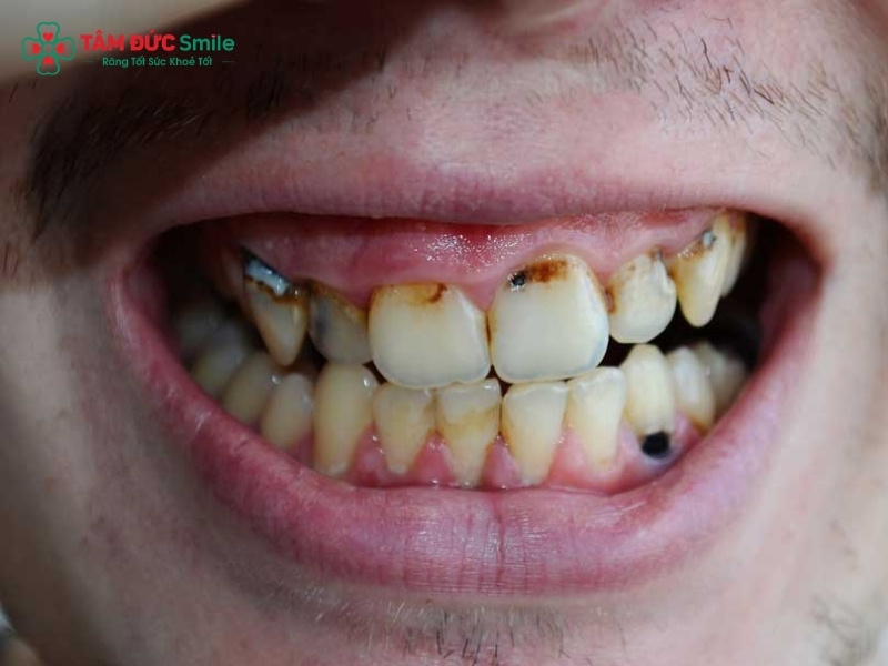 Răng nhiễm kháng sinh: nên tẩy trắng, dán sứ hay Abc8.com Thể thao, Đá gà, Xổ số, Bắn cá?