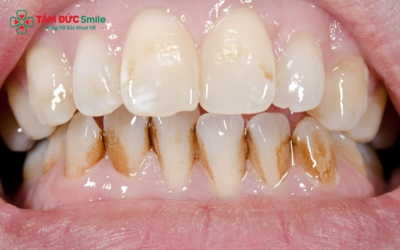 Răng có thể bị nhiễm màu từ các tác nhân bên ngoài như thực phẩm, thuốc lá hoặc do các yếu tố bên trong như dùng thuốc kháng sinh Tetracycline.