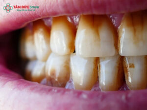 Răng nhiễm màu: Nguyên nhân, tẩy trắng, dán sứ, bọc sứ