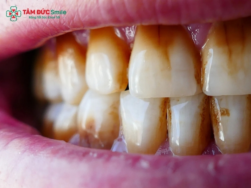 Răng nhiễm màu: Nguyên nhân, tẩy trắng, dán sứ, bọc sứ