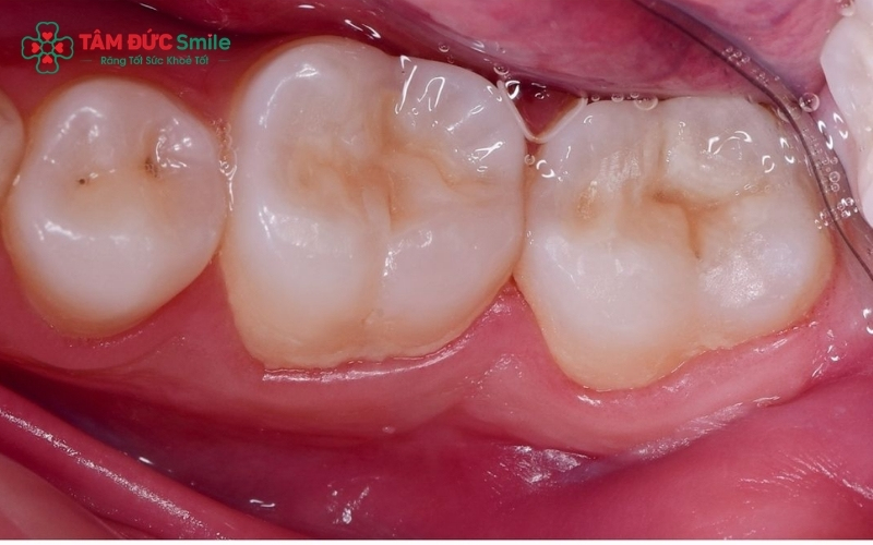 Ở giai đoạn chớm sâu (xuất hiện đốm trắng), việc tăng cường Fluoride và vệ sinh đúng cách có thể giúp tái khoáng hóa, ngăn chặn ABC88 com đăng nhập tiến triển.