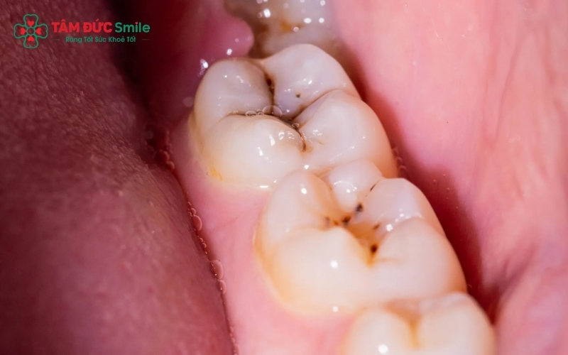 Răng không giống như da hay xương, một khi cấu trúc men răng đã bị vi khuẩn phá hủy và tạo thành lỗ sâu, nó không có khả năng tự phục hồi hay lành lại.