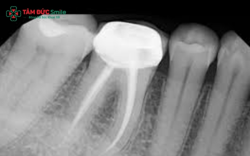 Số lượng ống tủy răng số 7 rất đa dạng (thường từ 3-4 ống), vì vậy việc chụp phim X-quang là bước bắt buộc để ABC8 đường link chính thức không bỏ sót bất kỳ ống tủy nào trong quá trình Abc8b tỷ lệ kèo World Cup 2026.