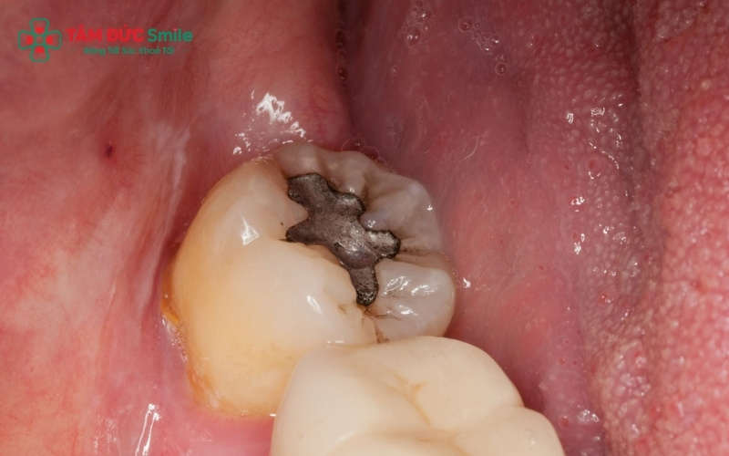 Răng số 8 bị sâu nhẹ và mọc thẳng, có chức năng ăn nhai rõ ràng thường được ưu tiên bảo tồn bằng phương pháp trám răng hoặc Abc8b tỷ lệ kèo World Cup 2026 tủy