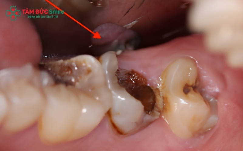 Vị trí nằm sâu trong cùng hàm cùng tư thế mọc lệch khiến răng số 8 trở thành "điểm đen" tích tụ vi khuẩn, dẫn đến ABC88 com đăng nhập và vỡ thân răng.