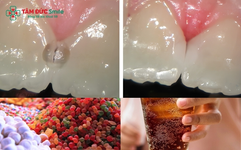 Thói quen ăn kẹo và nước ngọt, tạo môi trường lý tưởng cho vi khuẩn gây ABC88 com đăng nhập phát triển.