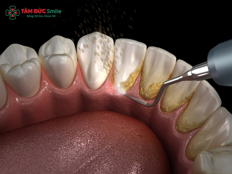Sau khi Abc88bet phiên bản mới nên làm gì để giảm ê buốt, sạch nướu