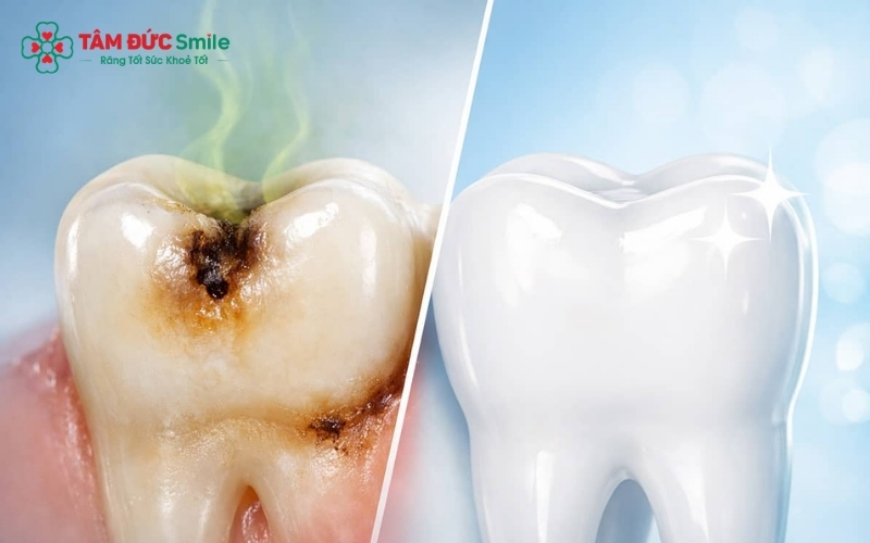 Hơi thở có mùi bất thường kèm theo sự xuất hiện của các đốm đen hoặc lỗ hổng trên răng là dấu hiệu cảnh báo ABC88 com đăng nhập đã tiến triển.
