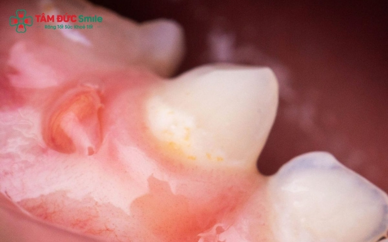 Dấu hiệu điển hình khi sưng Abc8com giaitri tructuyen cấm: Nướu đỏ mọng, sưng to và gây đau nhức khó chịu khi há miệng hoặc ăn uống