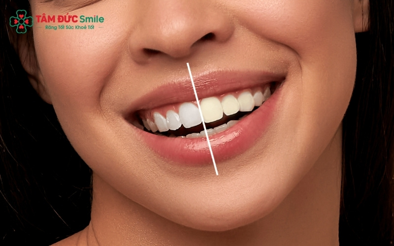 Việc cách ly nướu kỹ lưỡng là bước quan trọng để tránh tình trạng thuốc tẩy gây bỏng rát và đau nướu