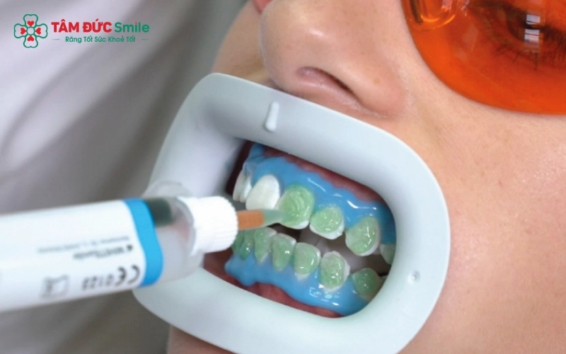 Sau khi tẩy trắng, men răng đang trong trạng thái nhạy cảm và dễ hấp thụ màu sắc từ thực phẩm nhất.