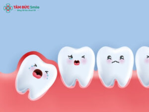 Thịt thừa ở răng khôn: Dấu hiệu lợi trùm, cách xử lý an toàn